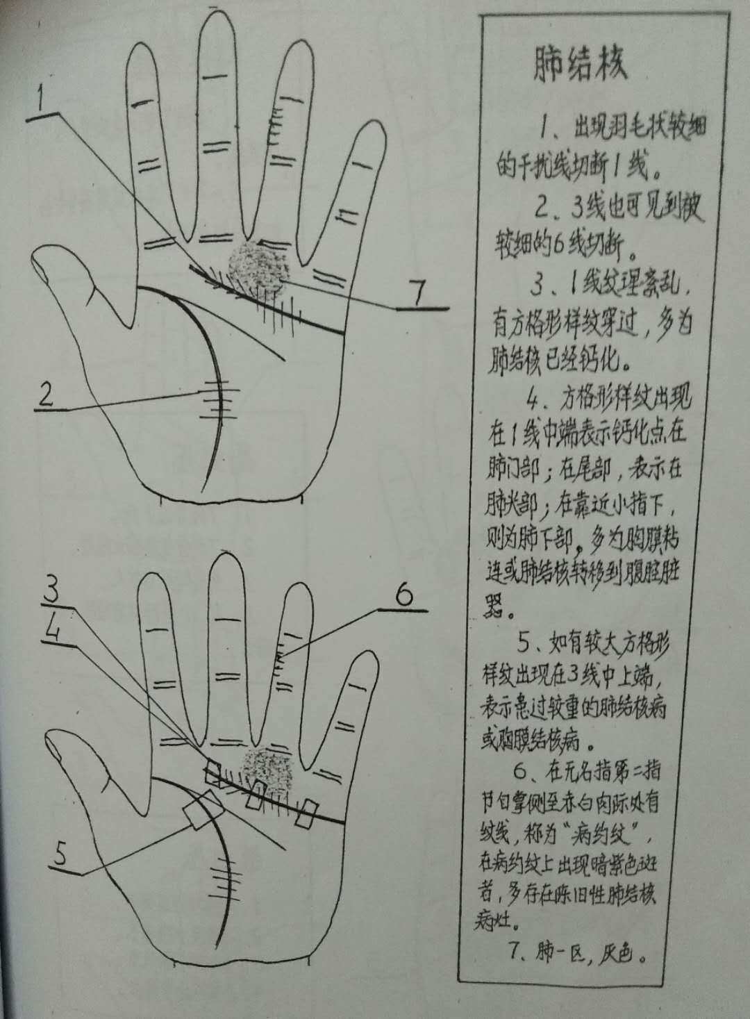 手相黑痣图解 （李向东）哪些痣是有福气的痣相，有你吗？